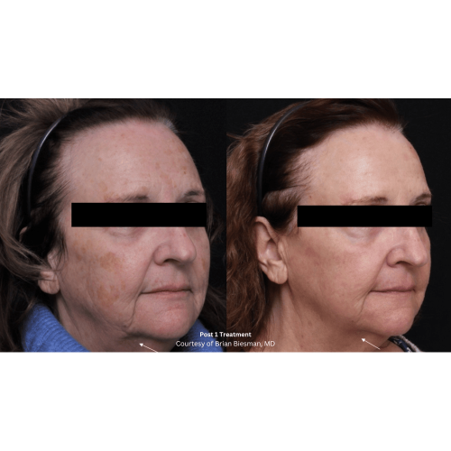 Beforeafter-Biesmasn-1